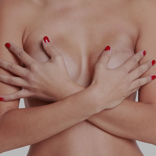 Symétrisation du sein controlatéral après cancer du sein